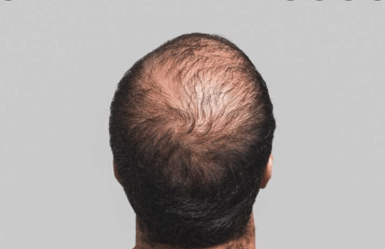 Hair Loss Treatment vs Laser Hair Therapy